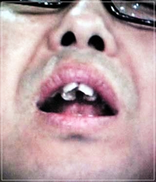 ウエストランド井口の前歯は歯列矯正済み？歯並びが気持ち悪いと話題！